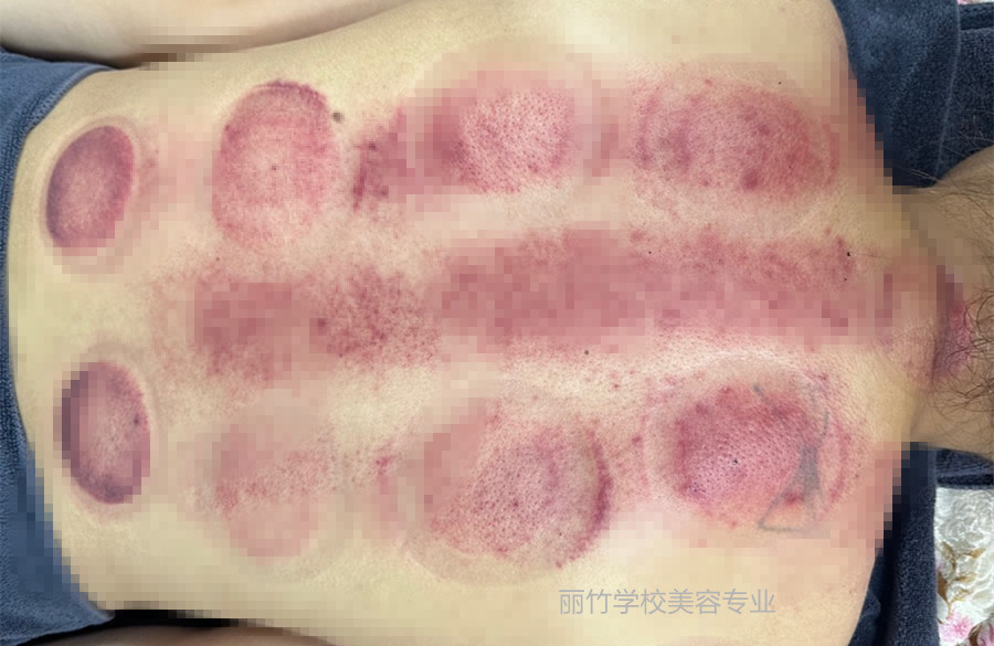 拔火罐的顏色代表什么？南寧美容美體專業(yè)實訓(xùn)